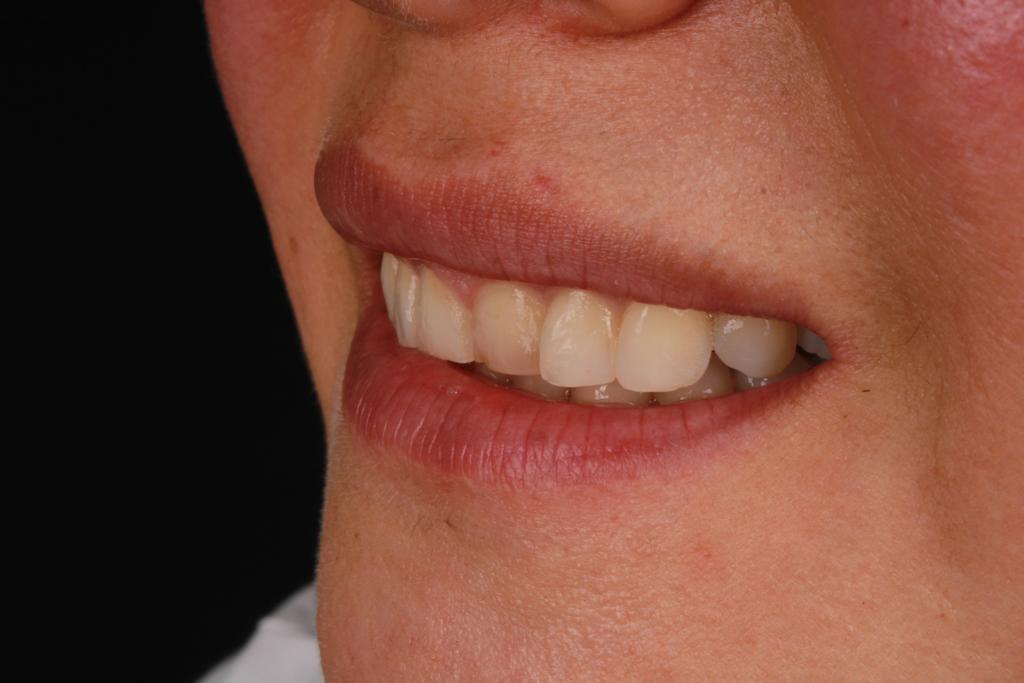 Antes diseño dental